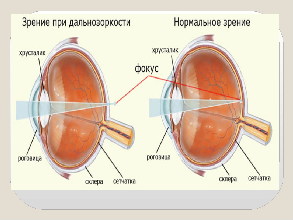 Когда после замены хрусталика восстанавливается зрение глаза. Миопия гиперметропия астигматизм пресбиопия. Строение глаза дальнозоркость. Миопия дальнозоркость астигматизм. Нормальное зрение и дальнозоркость.