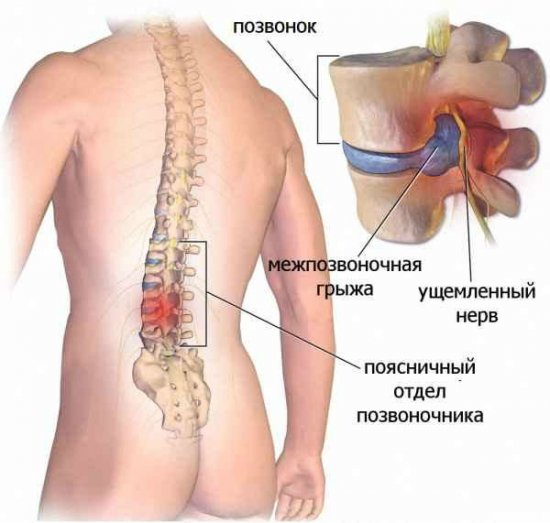 Грыжа позвоночника