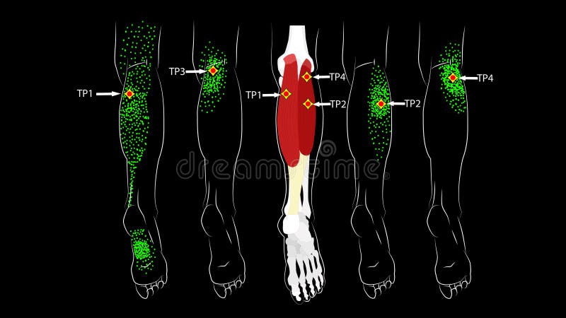 Calf muscle. Trigger points in the leg, reflected pain on the back of the thigh and in the foot. Leg pain. Calf muscle. Trigger points in the leg, reflected pain vector illustration