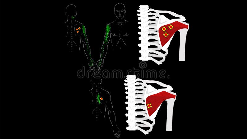 Infraspinatus muscle. Trigger points and pain in the arm and shoulder blade. The deep muscles of the arm. Image on a black. Infraspinatus muscle. The deep stock illustration