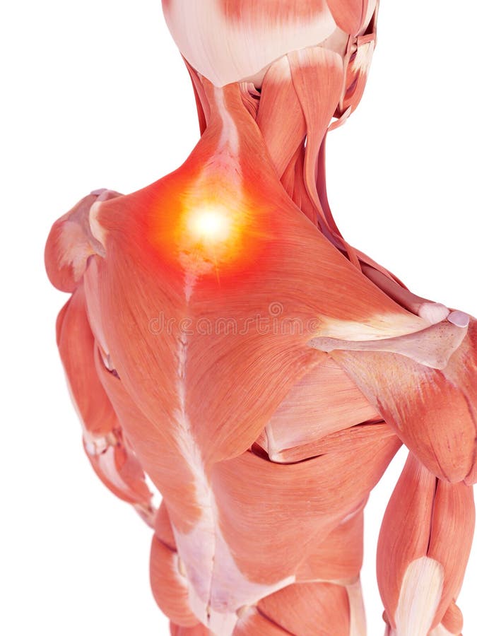 The back muscles showing pain. Medical accurate illustration of the back muscles showing pain royalty free illustration