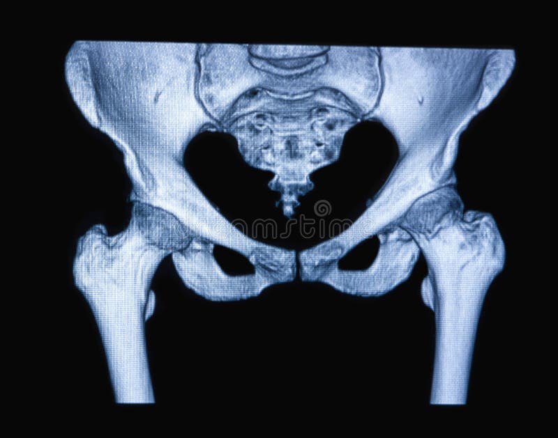 MRI scan of the hip joint royalty free stock image