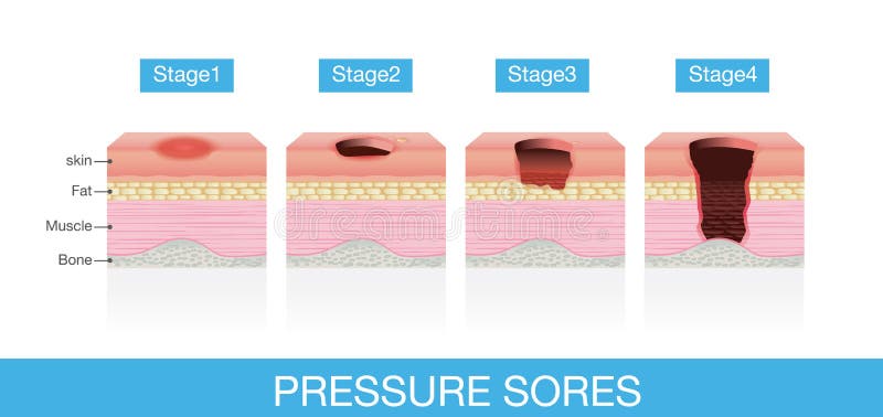 Stages of Pressure Sores. Of patient skin which extends from skin into muscles and bone. This is medical illustration stock illustration