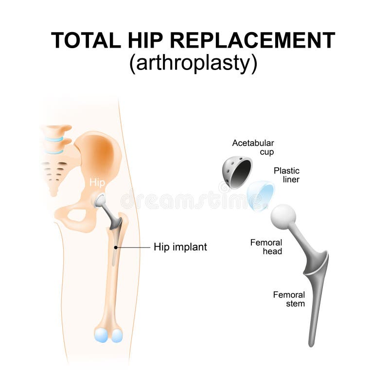Total hip replacement or arthroplasty. stock illustration