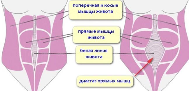 Что делать с обвисшей кожей на животе и боках после родов