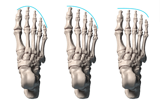 different toe lengths