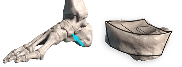 navicular bump and boat shape